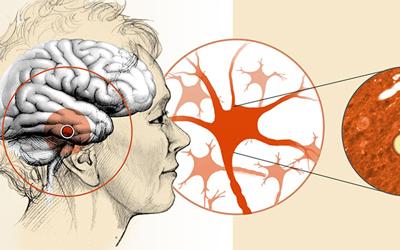 Aspetti cognitivi della demenza a corpi di Lewy (LBD): una sfida aperta